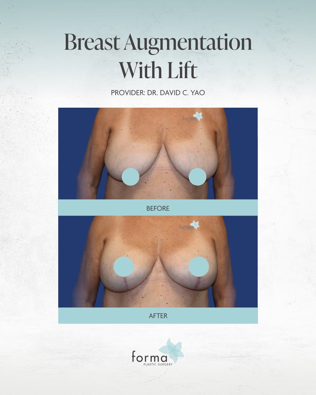 Instagram post by Dr. Molly F. Walsh: For this patient, the goal was to improve breast shape and position while adding volume for a more balanced overall appearance. Dr. Yao perf…