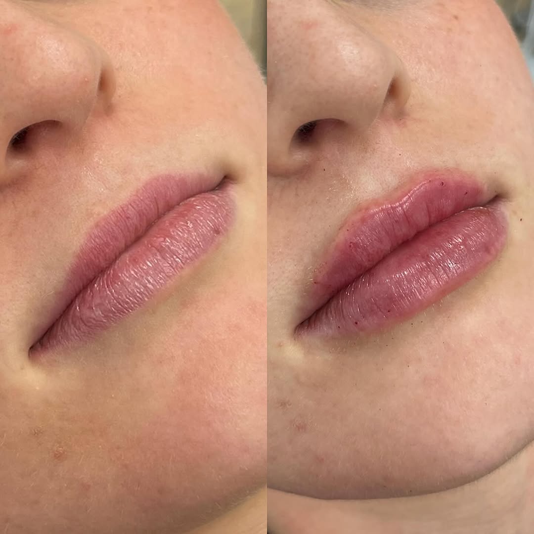 Instagram post by Dr. Molly M. Warthan: Natural-looking lip filler result 💉✨ Photo 1: before vs immediately after Photo 2: immediately after vs 4 weeks after Interested in booking…