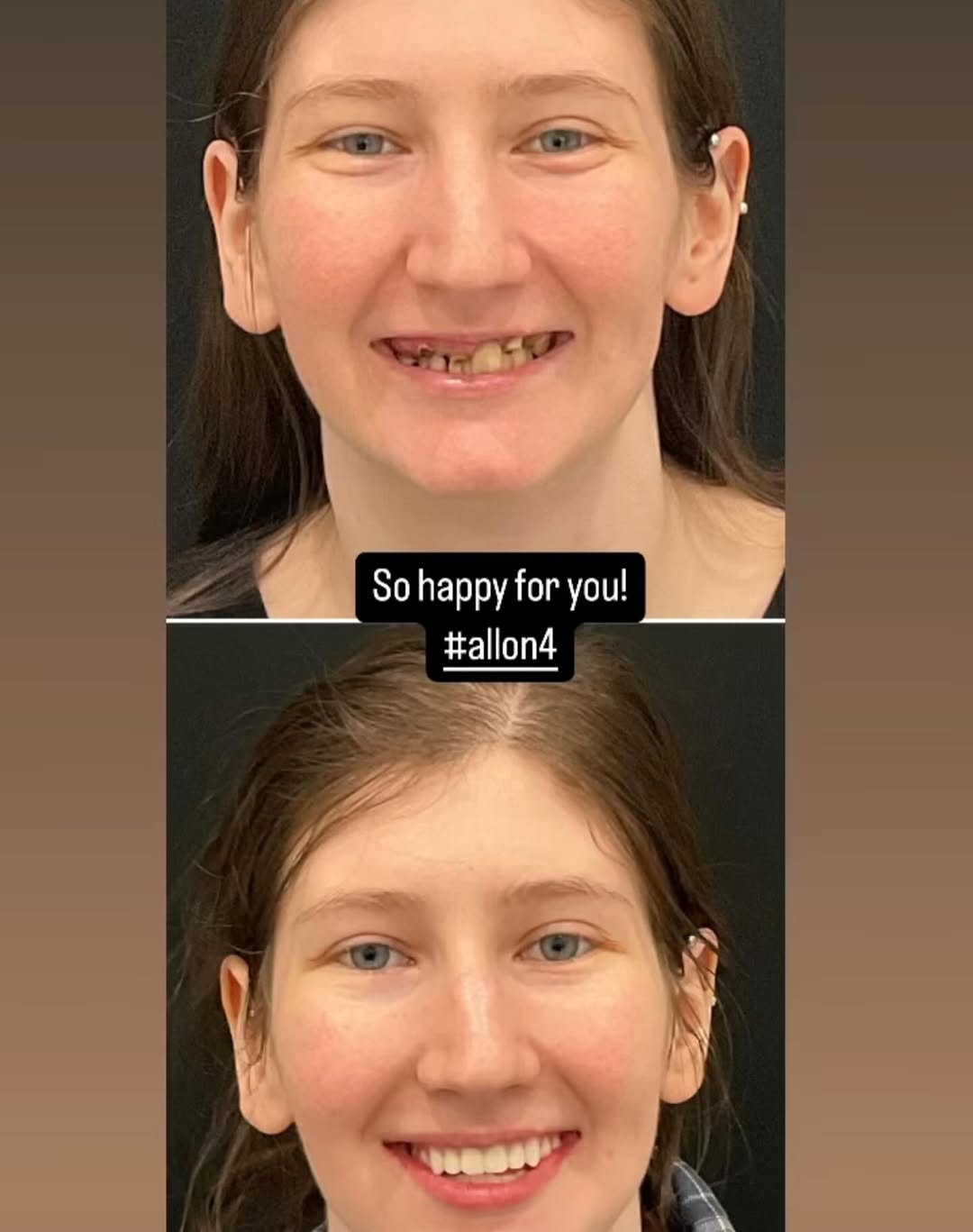 Instagram post by Dr. Mona Stone: What a beautiful patient inside and out and what a deserving smile! She has come a long way suffering from a genetic condition affecting her…