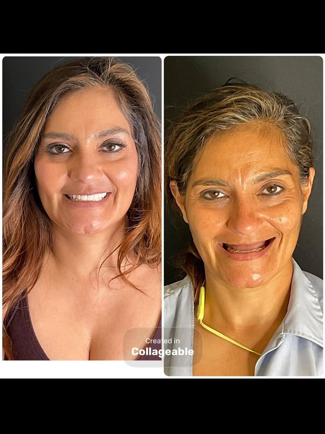 Instagram post by Dr. Mona Stone: But this transformation!!! This was a difficult case as our patient was severely collapsed in the midface but we manage to transform not onl…