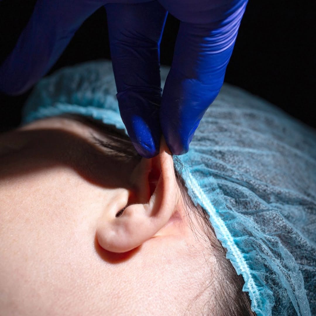 Instagram post by Dr. Moneer Jaibaji: There is minimal discomfort associated with otoplasty recovery. Most patients can go back to work or school after about two weeks! #earsurge…