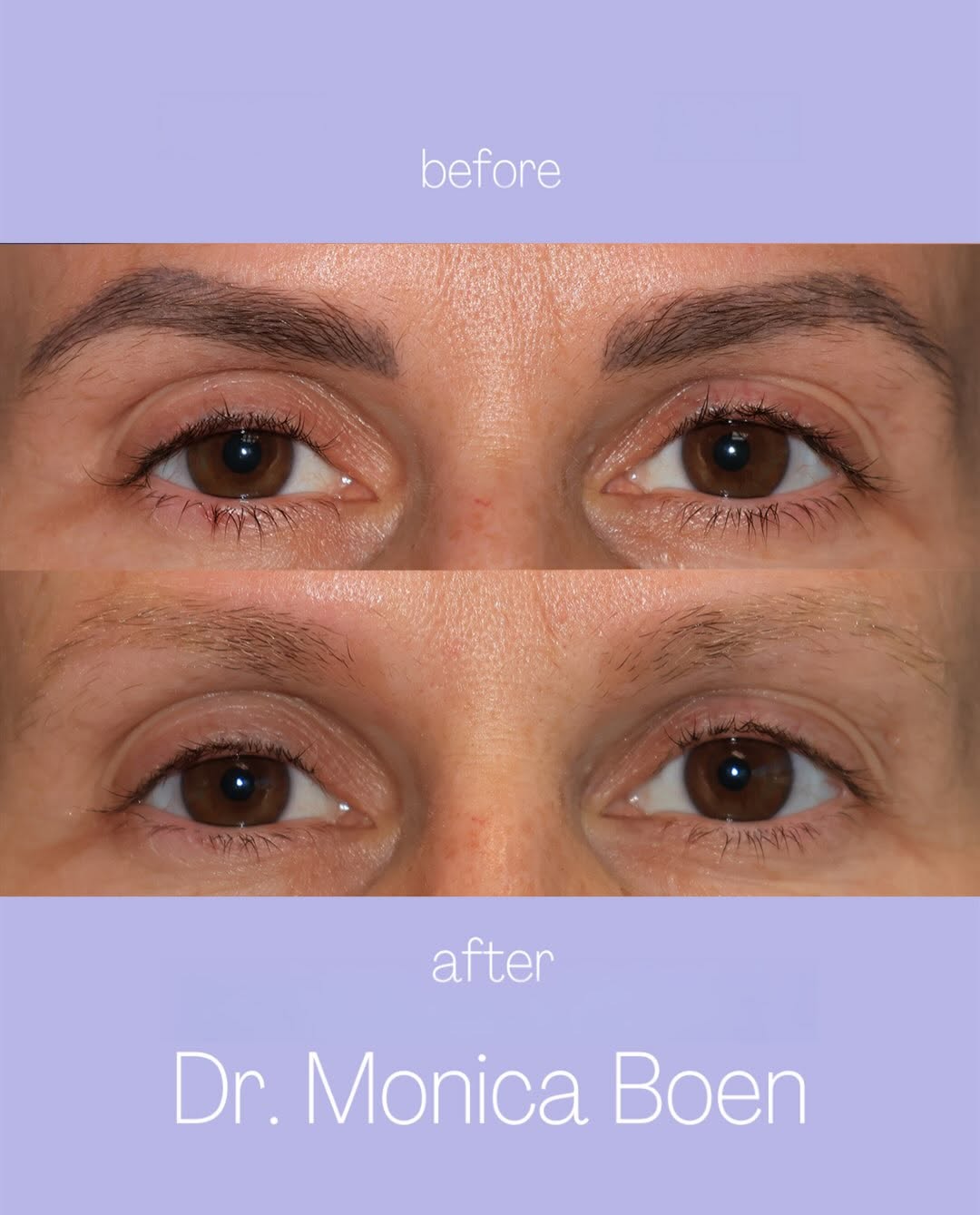 Instagram post by Dr. Monica Boen: Eyebrow trends have been changing and if you would like your microbladed eyebrows removed, picosecond lasers work best!🤍 Microbladed eyebro…