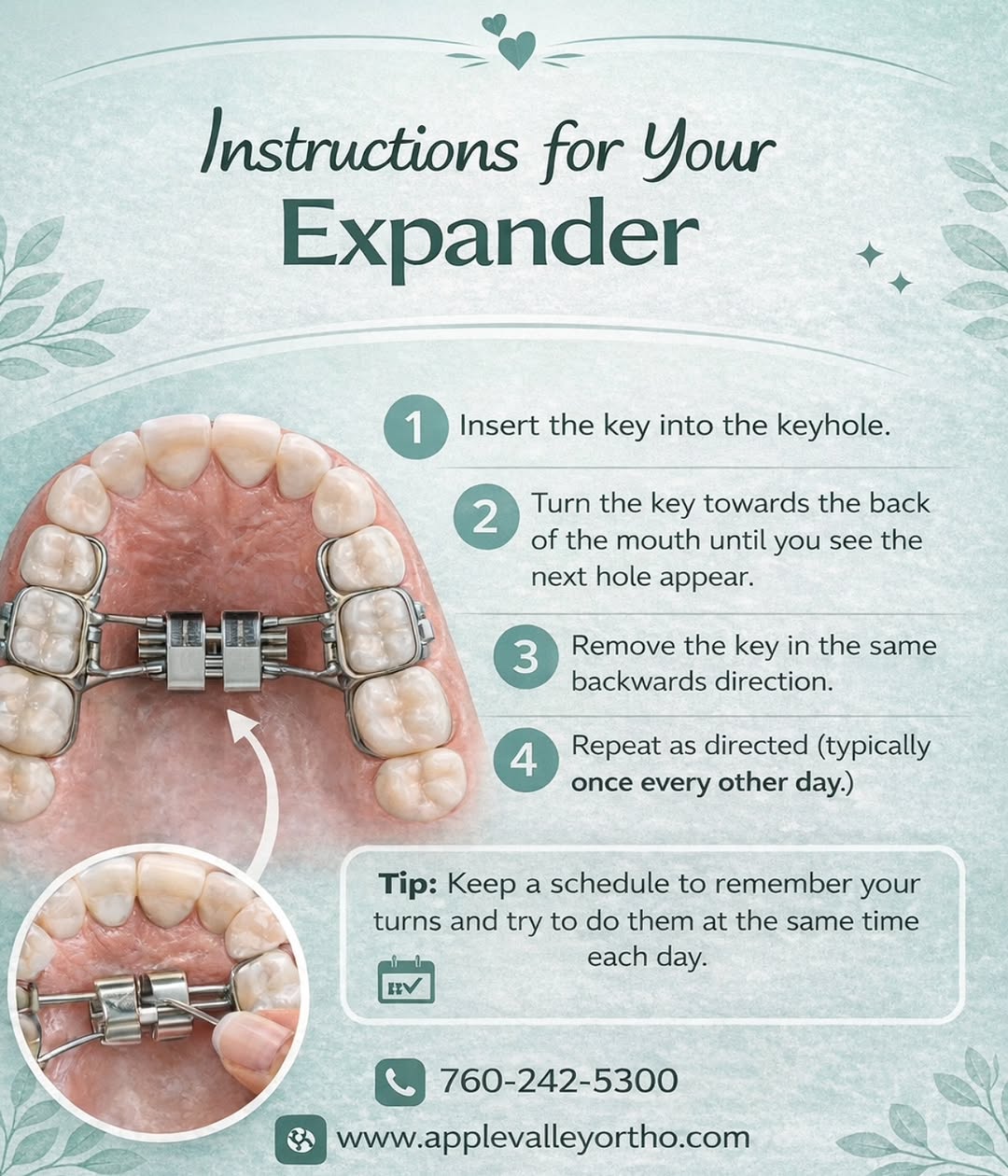 Instagram post by Dr. Monica Velez, D: Getting used to your expander can feel a little overwhelming at first—but you’ve got this! 💪🦷 Following your turn instructions consistentl…