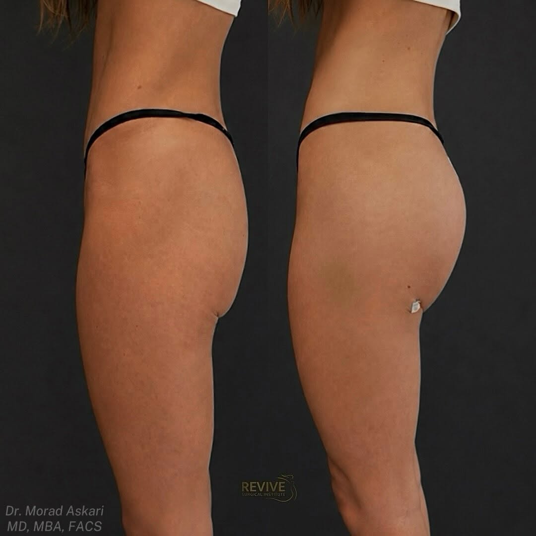 Instagram post by Dr. Morad Askari: Subtle changes can make a beautiful difference✨ This patient chose AlloClae to enhance her natural shape and create a more balanced contour …