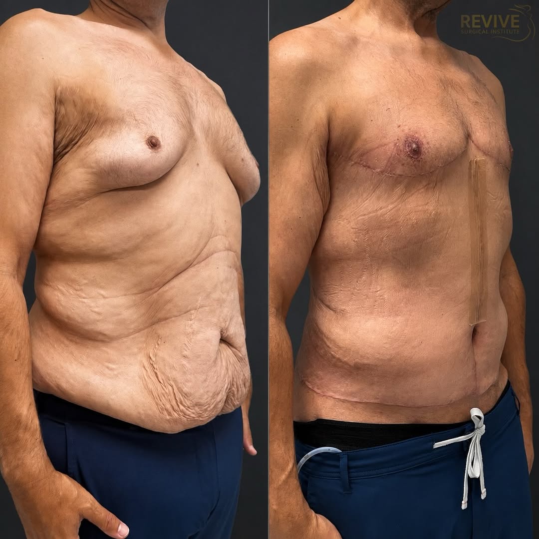Instagram post by Dr. Morad Askari: Every patient’s body contouring journey is unique.✨ For this patient, we combined multiple procedures to address excess skin, contour the wa…