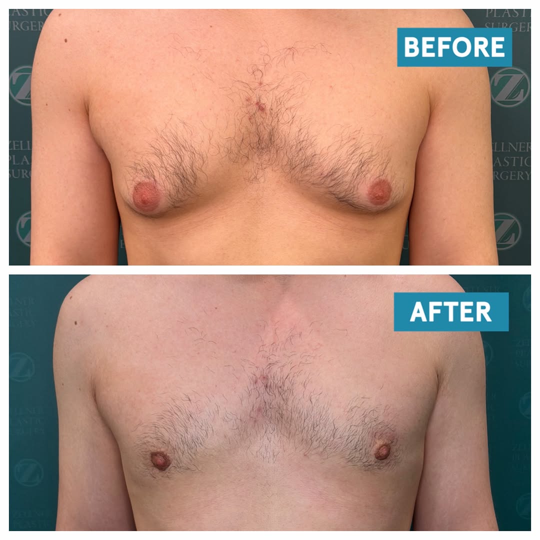Instagram post by Dr. Mordcai Blau: We have been so busy lately that it’s been awhile since we posted gynecomastia results. This lovely young man is just six months out from su…