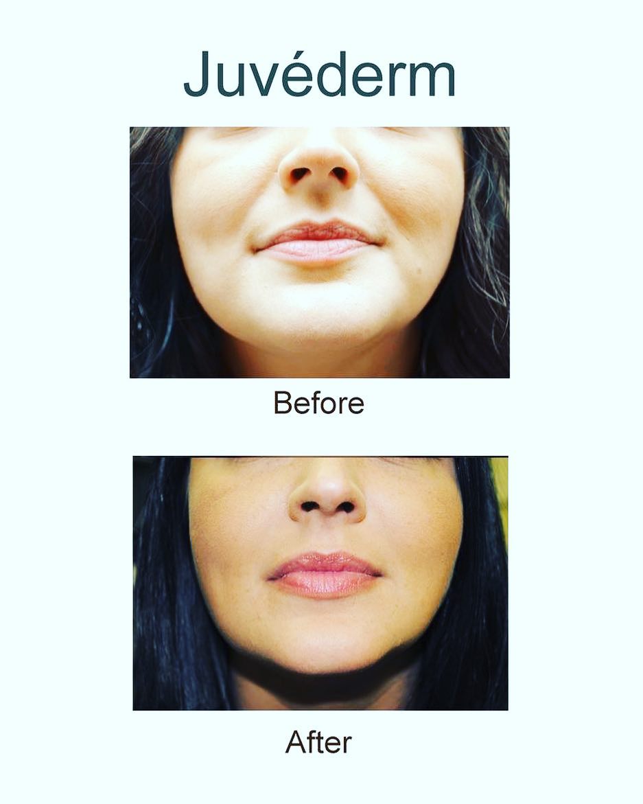 Instagram post by Dr. Moriah Moffitt: 30 mins until you look and feel refreshed and well rested 🙌🏼🙏🏼 WE ❤️ JUVEDERM!