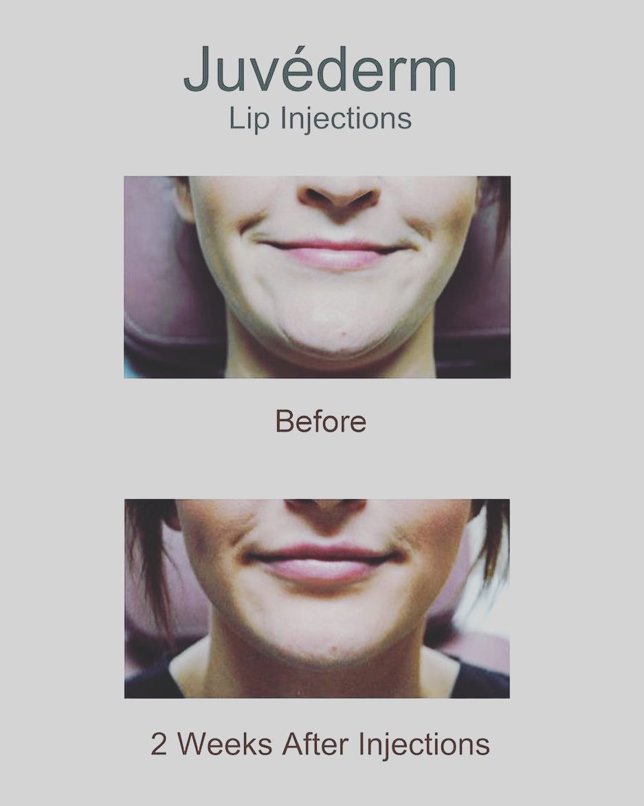 Instagram post by Dr. Moriah Moffitt: Schedule your appointment today for your Juvederm and/or Botox!