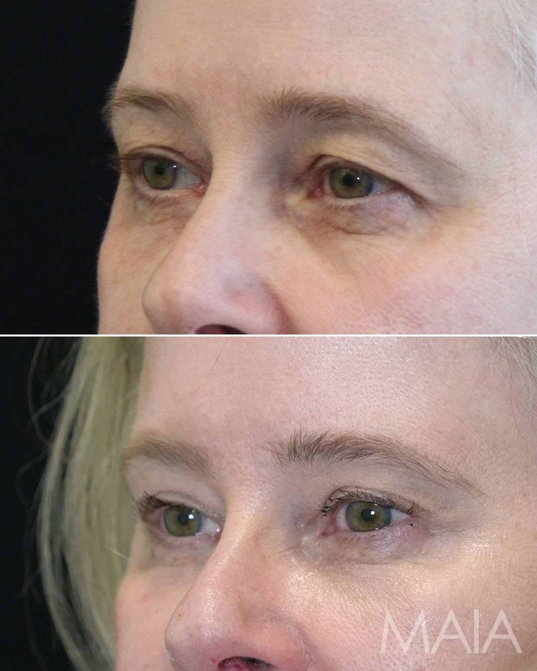 Instagram post by Dr. Munique Maia: We shared her full transformation last week. Now let’s look closer at the eyes. This is where precision matters most. • Mini temple lift to …