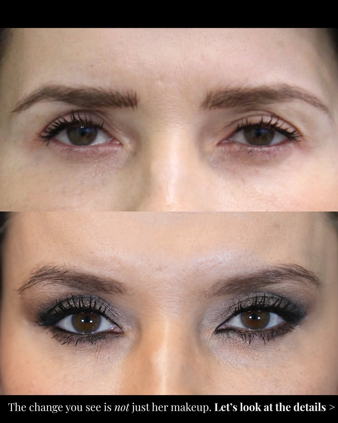 Instagram post by Dr. Munique Maia: At 50, she wanted her eyes to look brighter, smoother, and more rested while preserving a natural, elegant expression. For her, that meant a…