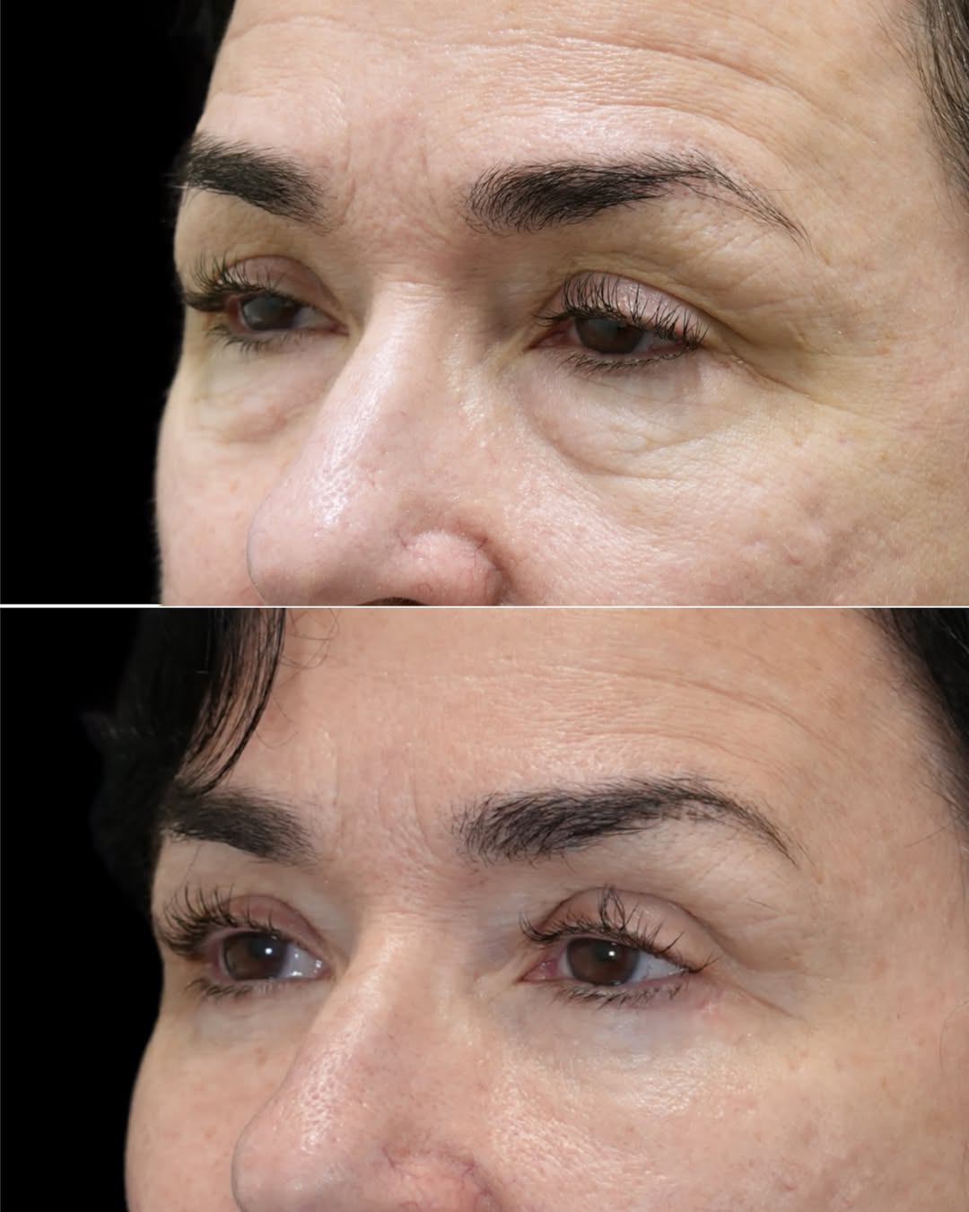 Instagram post by Dr. Munique Maia: At 62, she wasn’t looking to change her face. She simply wanted her eyes to reflect the energy and confidence she feels. Dr. Maia performed …