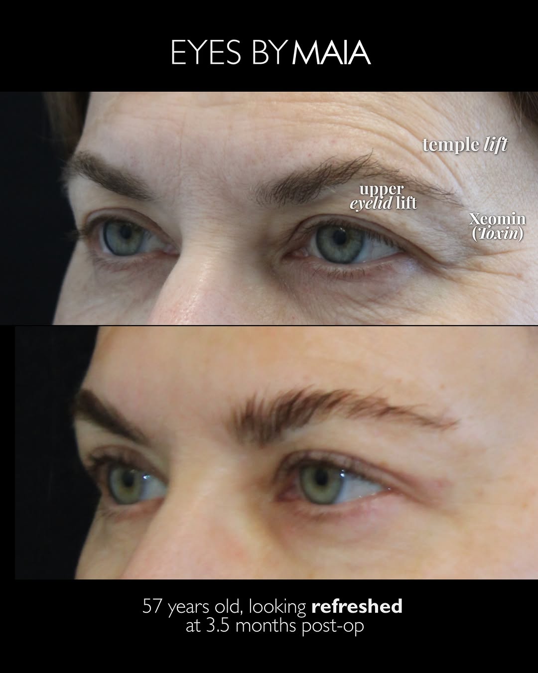 Instagram post by Dr. Munique Maia: Her biggest concern at age 57? Looking tired when she wasn’t. Heavy brows and excess upper eyelid skin were creating a more tired appearance…
