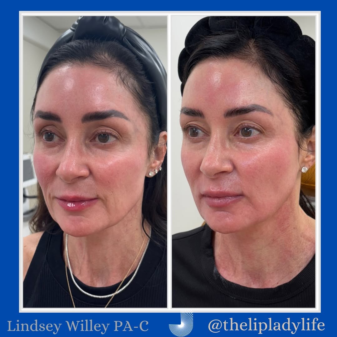 Instagram post by Dr. Myles S. Jerdan: ✨THE LONG GAME✨ Here is 6 months post her injectable maintenance appointment and right before laser maintenance. (June 2025 —> January 2026)…