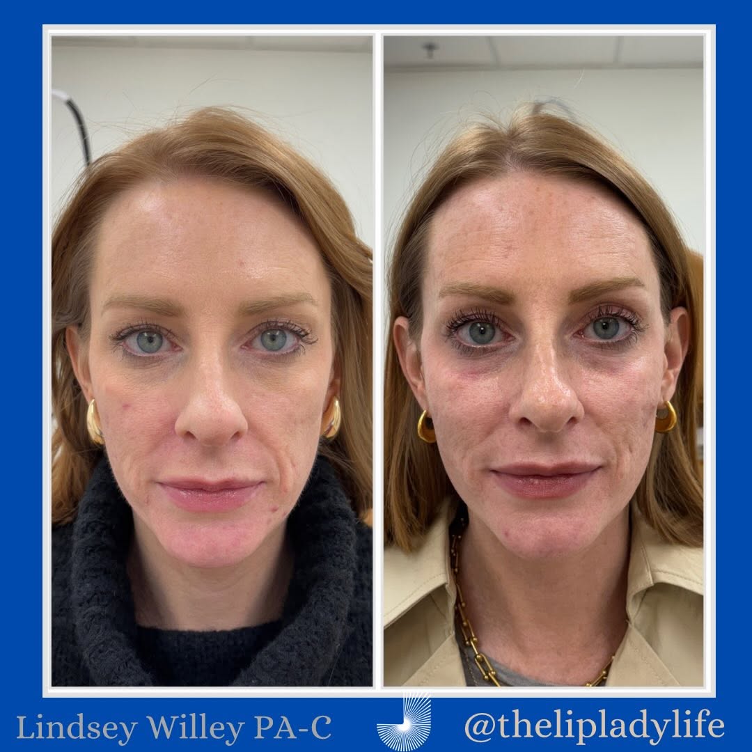 Instagram post by Dr. Myles S. Jerdan: You got a treatment plan and stuck with it! Grateful to tag team with the best @drskinberly I am excited to see the progress continue this y…
