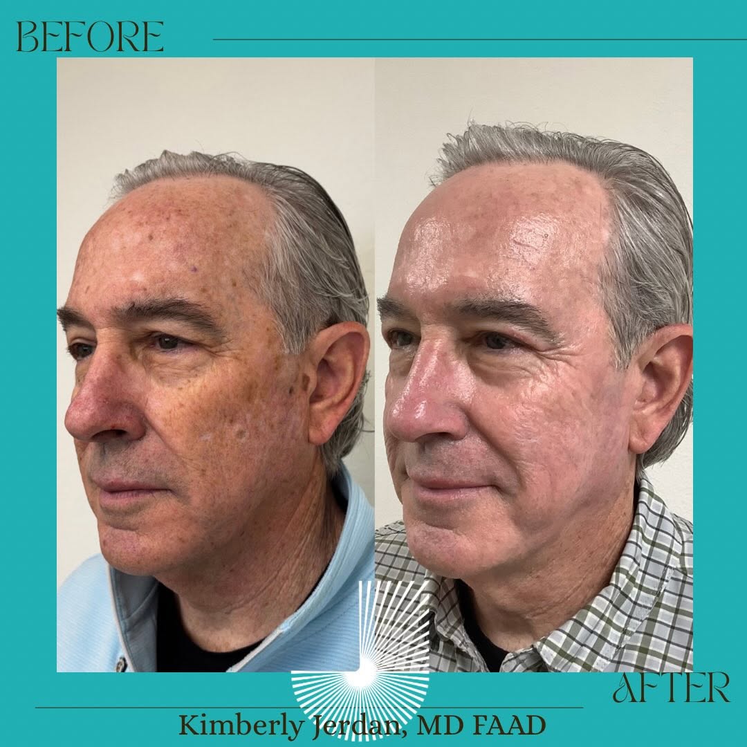 Instagram post by Dr. Myles S. Jerdan: That 2 week follow up…. Chef’s kiss! There’s nothing that I love more than a man clean up. Because we do it in a beautiful way that makes yo…