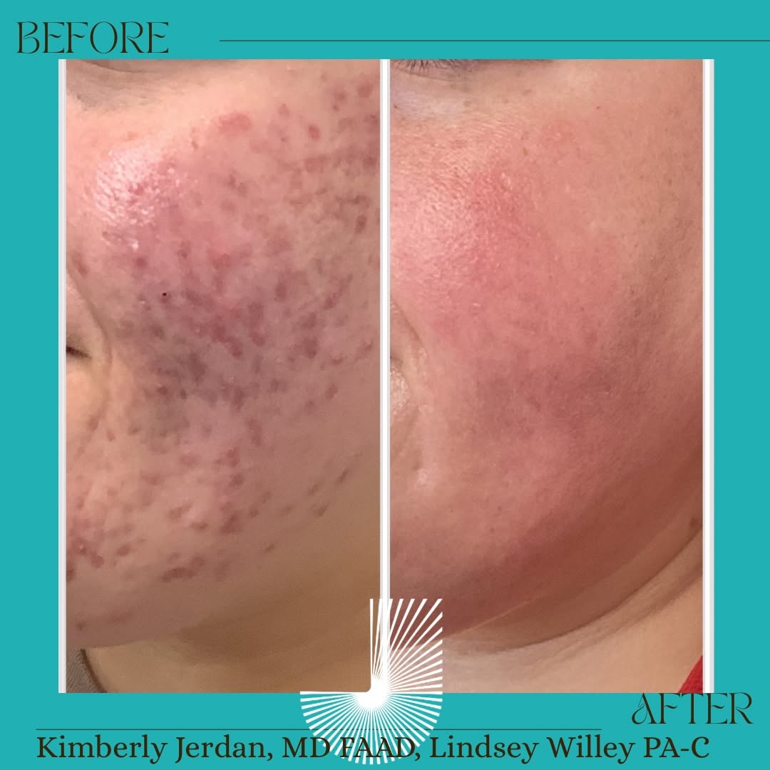 Instagram post by Dr. Myles S. Jerdan: Two years ago I made the move to @jerdandermatologylaser ! You don’t know what you don’t know. I’m so grateful I took the leap and @drskinbe…