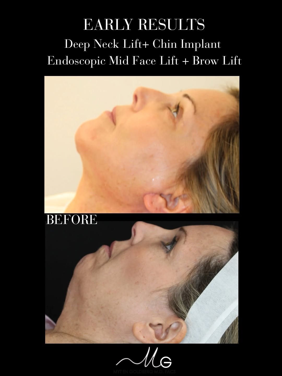 Instagram post by Dr. Mytien Goldberg: Early results of after a deep neck lift, endoscopic brow lift, and endoscopic midface lift ✨ This combination of facial rejuvenation procedu…