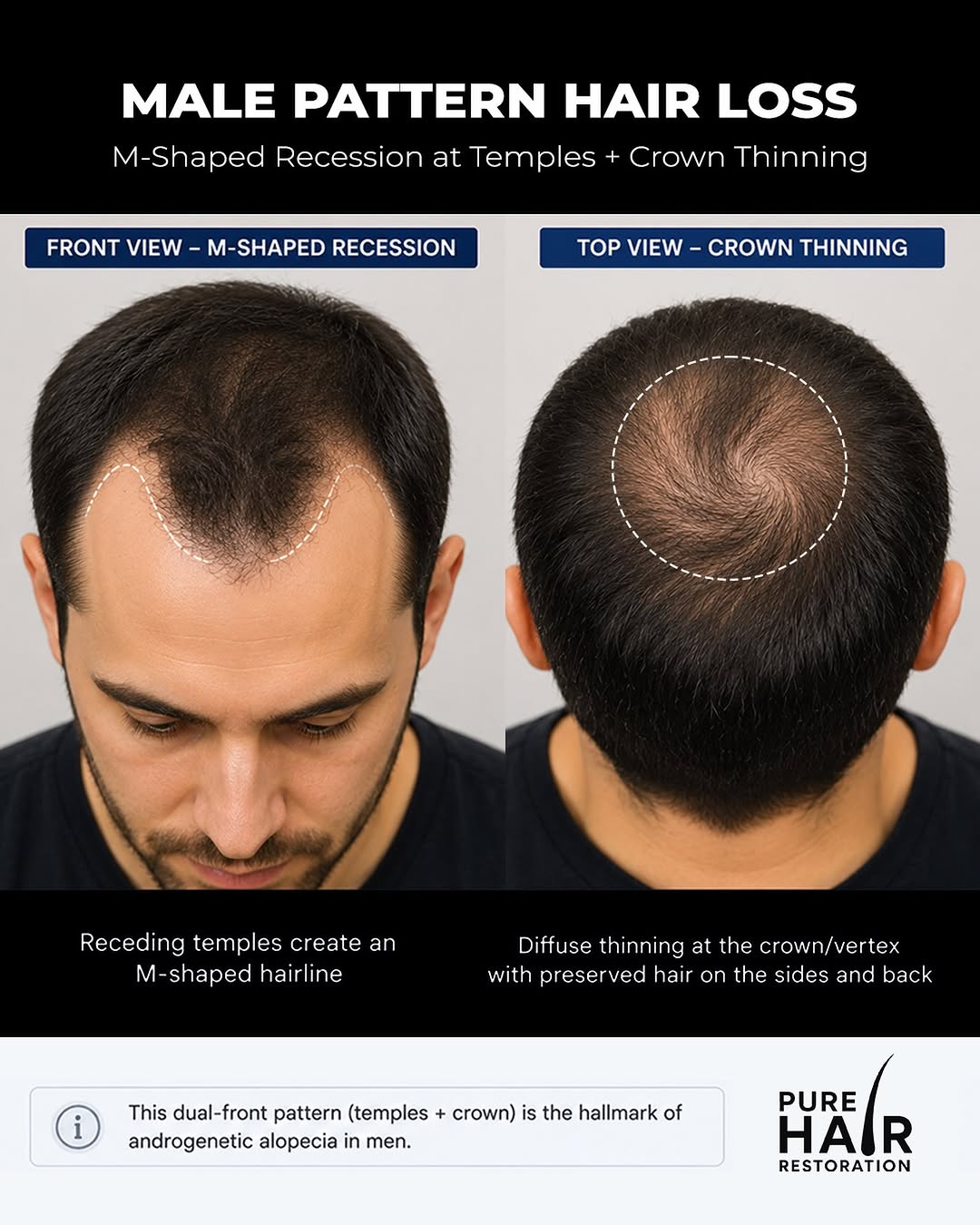 Instagram post by Dr. Nader Ronaghi: Male pattern hair loss often follows a predictable pattern, with recession at the temples and gradual thinning through the crown. The good n…