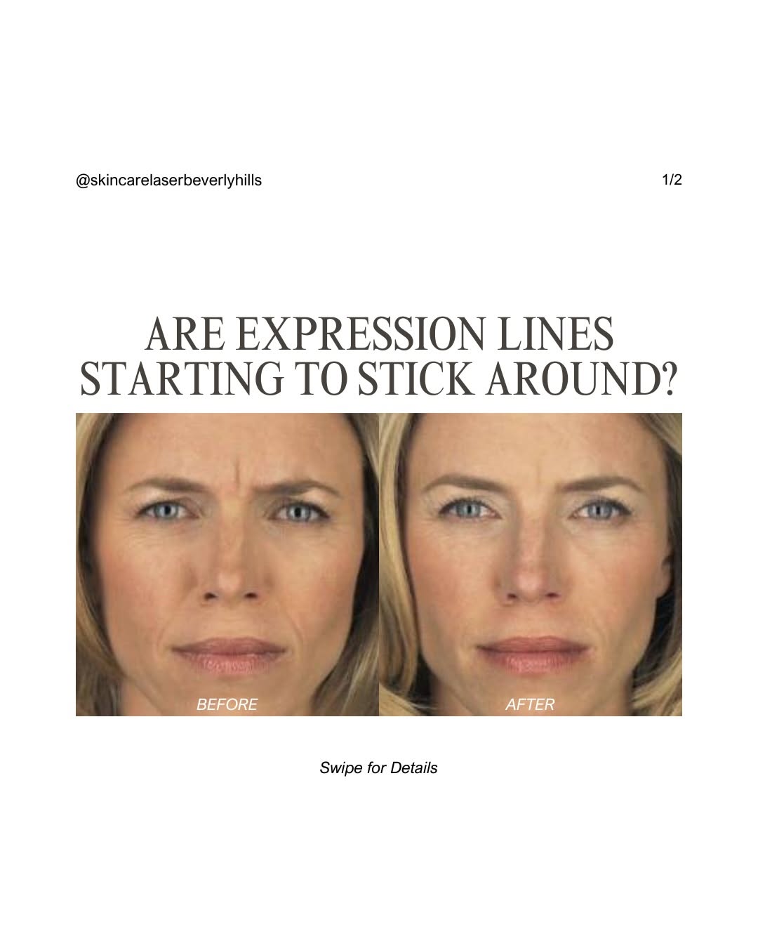 Instagram post by Dr. Naissan Wesley: Expression lines don’t have to stick around. Our expert team uses Botox to smooth existing lines, prevent deeper wrinkles, and deliver natur…