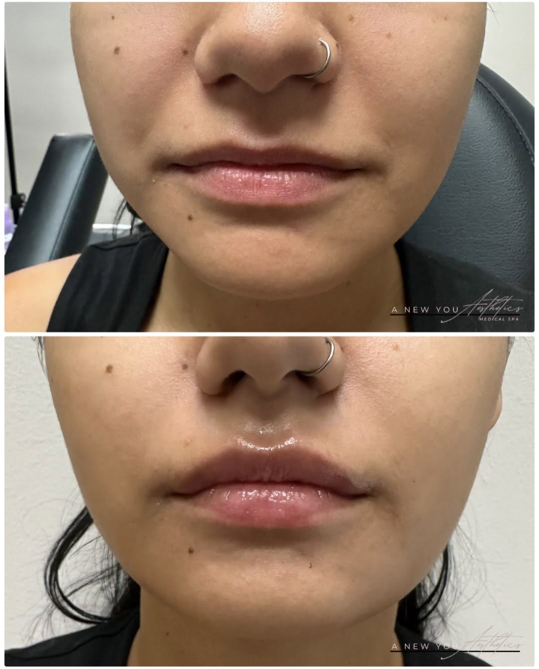 Instagram post by Dr. Nalan Narine: Lips before and after one this cute beauty 👄✨ it was her first time and she couldn’t be happier 🤍 . . Treatment: mini lip pop 1/2 syringe …