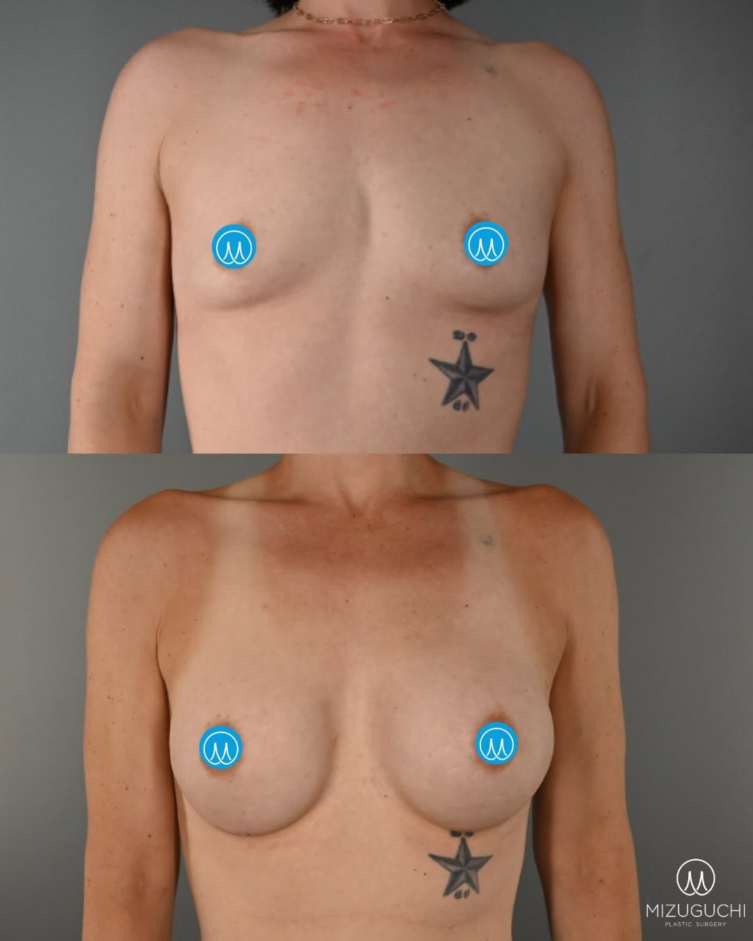 Instagram post by Dr. Nana N. Mizuguchi: ✨Breast Augmentation Transformation✨ This patient achieved, beautiful natural-looking enhancement with 255 cc #natrelleinspira implants plac…