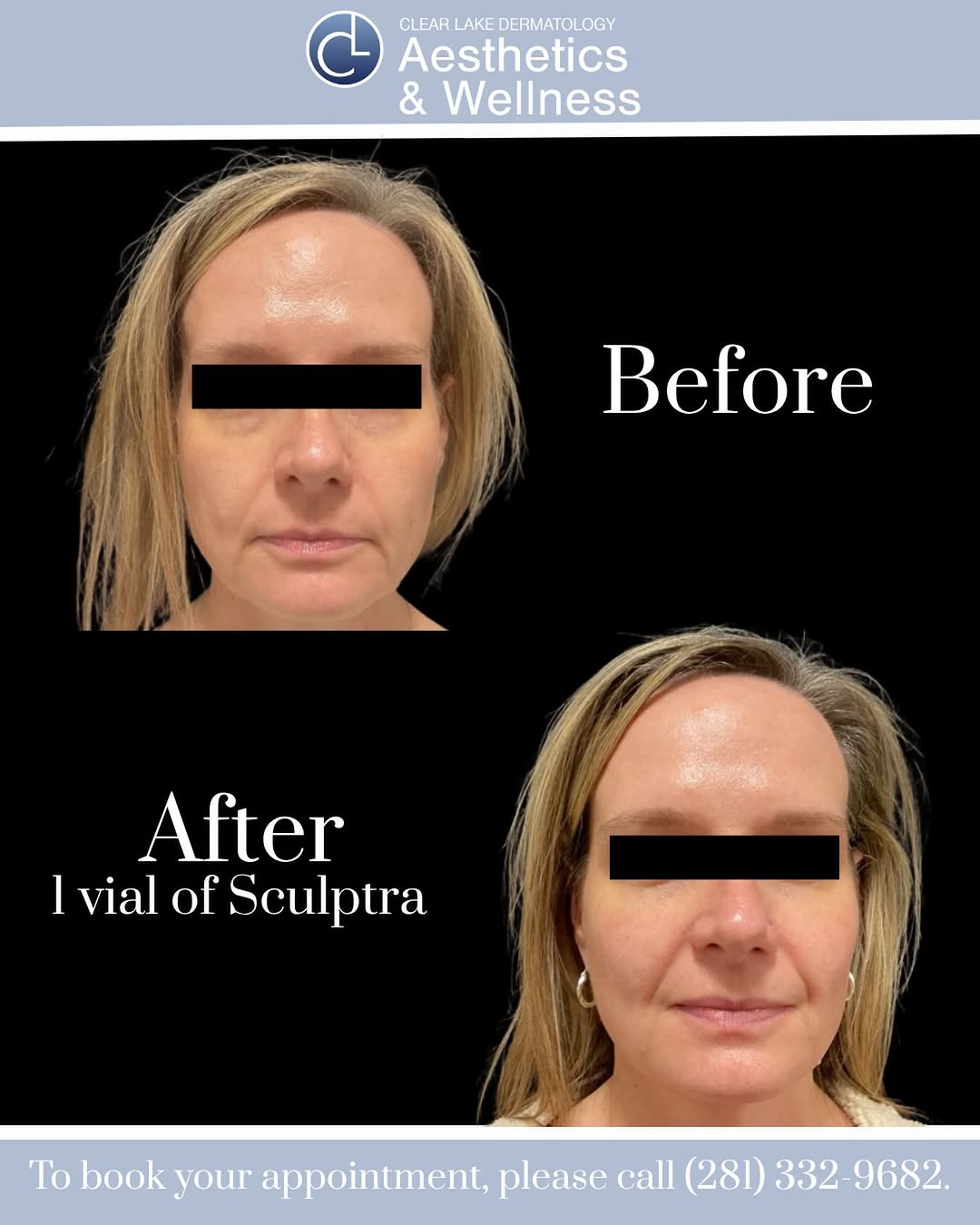 Instagram post by Dr. Narin (Joe) Apisarnthanarax: ✨ Can you feel the glow yet? Only 1 month after a single Sculptra treatment and she’s already looking naturally refreshed, lifted, and radia…