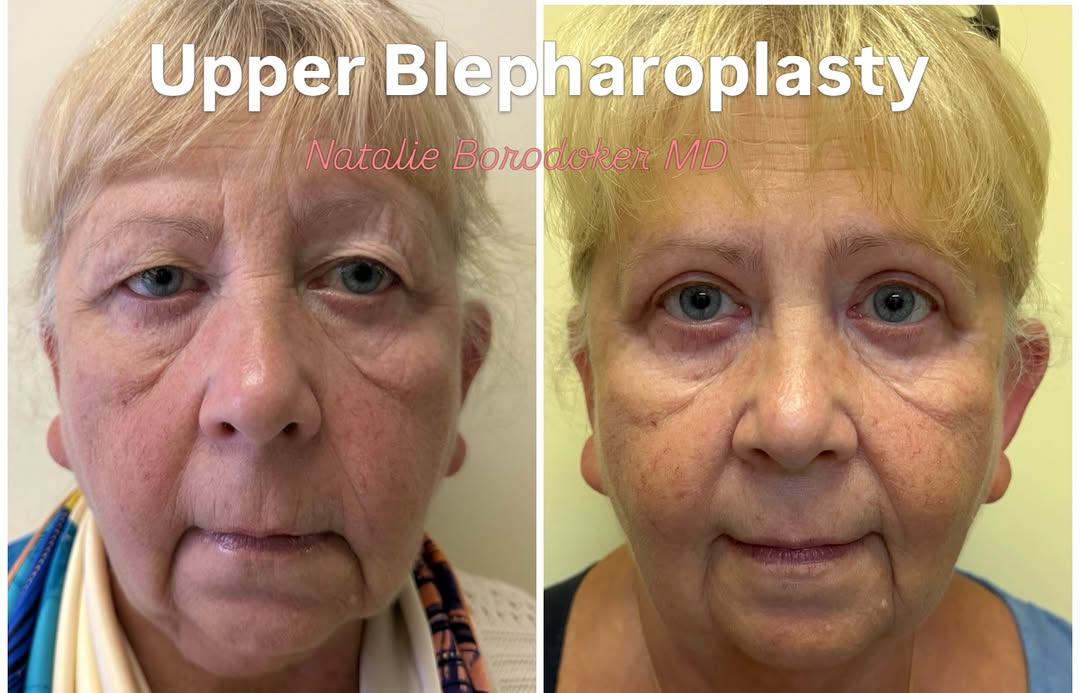 Instagram post by Dr. Natalie Borodoker: Six months after Upper Blepharoplasty, contemplating lower lid surgery. Happy with her results. Eyes look natural, the vision is improved an…