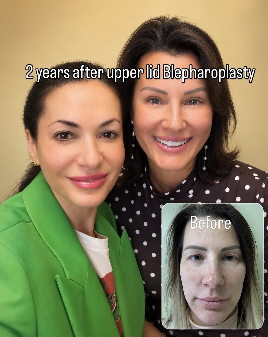 Instagram post by Dr. Natalie Borodoker: It has been a little over two years after her upper blepharoplasty. She is very pleased with her result! Schedule your consultation 📞718517…