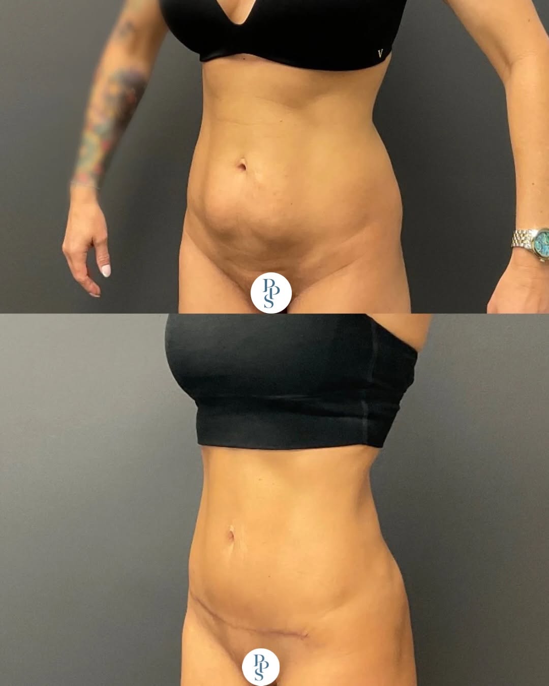 Instagram post by Dr. Natan Yaker: This patient is only just 7 weeks out from her mini tummy tuck with flank liposuction, and her transformation is already taking shape and lo…