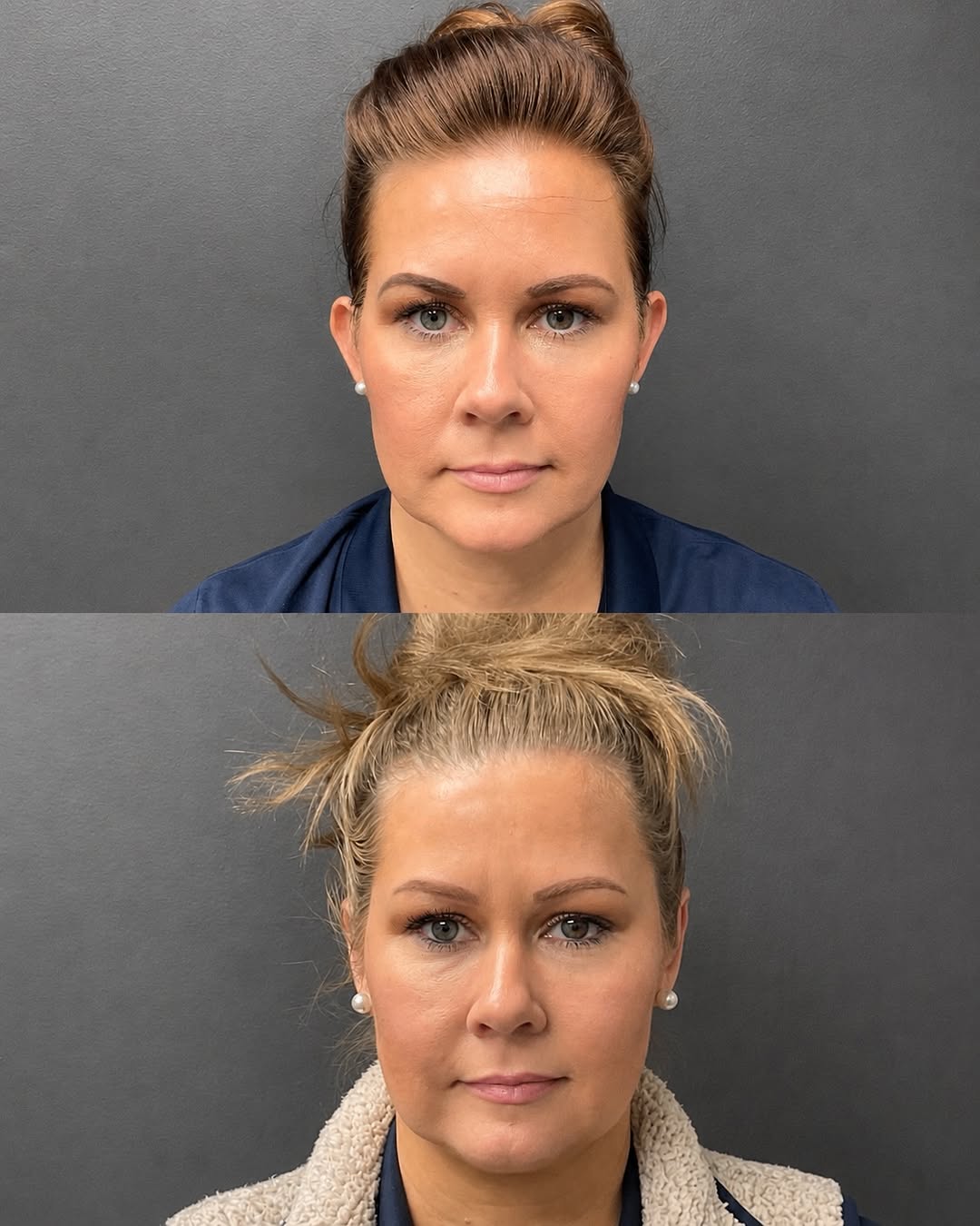 Instagram post by Dr. Natan Yaker: Small change, big impact. ✨ Otoplasty (ear surgery) is designed to reshape, reposition, or bring prominent ears closer to the head for a mor…