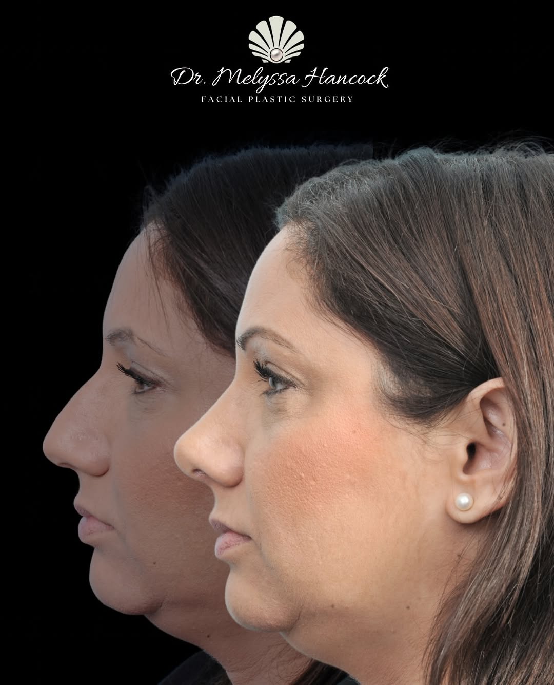 Instagram post by Dr. Nathan E. Nachlas: A subtle refinement can make such a beautiful difference. This rhinoplasty created a smoother profile and more balanced nasal shape while ke…