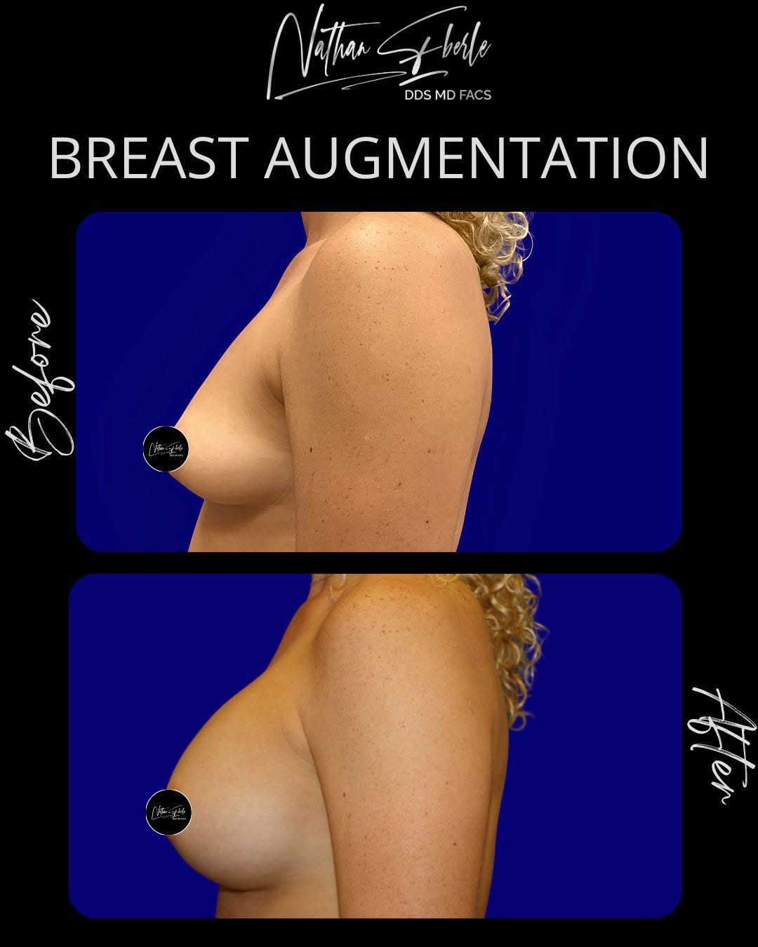 Instagram post by Dr. Nathan Eberle: Before and After: Breast Augmentation 📩 Schedule your consultation today, Link in Bio! 📱Contact us: (954) 507-4540 📧 info@PlasticSurgeryW…