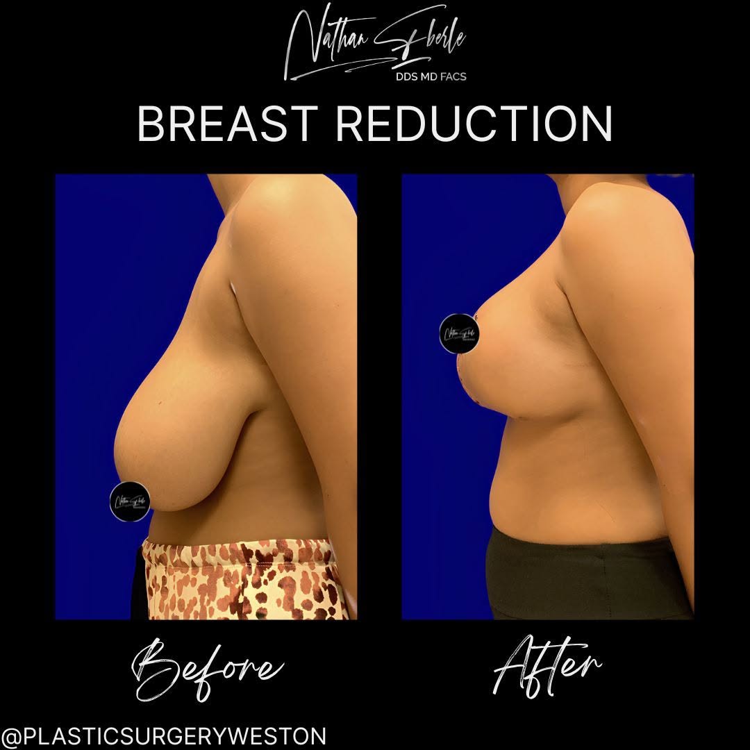 Instagram post by Dr. Nathan Eberle: Before and After: Breast Reduction 📩 Schedule your consultation today, Link in Bio! 📱Contact us: (954) 507-4540 📧 info@PlasticSurgeryWest…