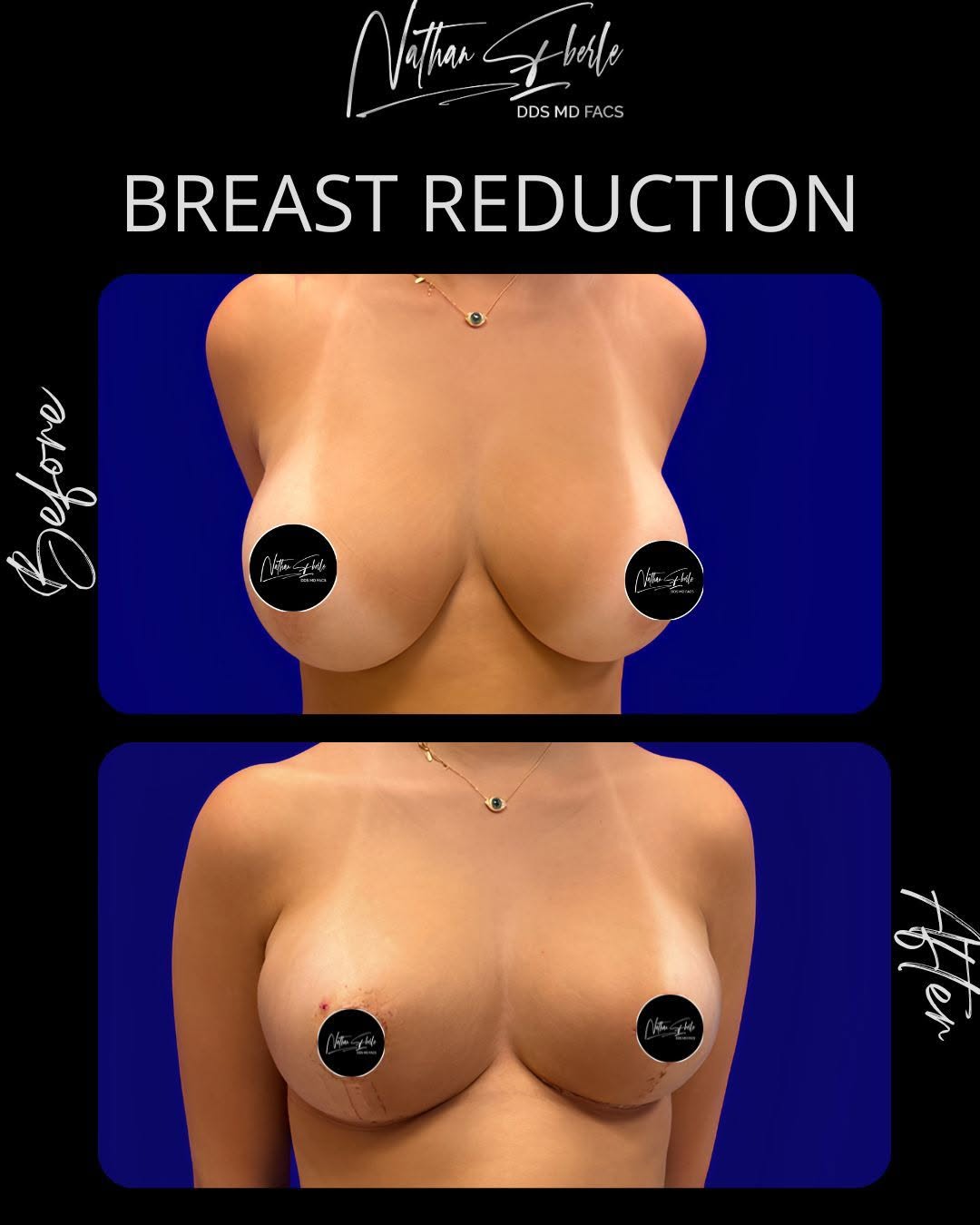Instagram post by Dr. Nathan Eberle: Before and After: Breast Reduction 📩 Schedule your consultation today, Link in Bio! 📱Contact us: (954) 507-4540 📧 info@PlasticSurgeryWest…