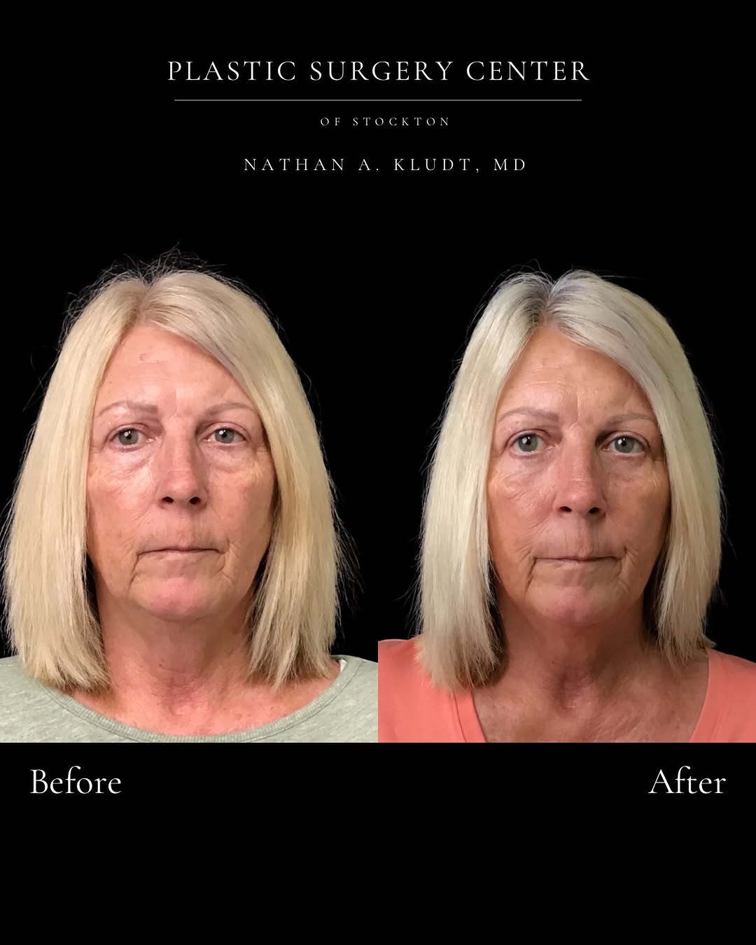 Instagram post by Dr. Nathan Kludt: What is a lower blepharoplasty? A lower blepharoplasty, also known as lower eyelid surgery, is a procedure designed to improve the appearanc…