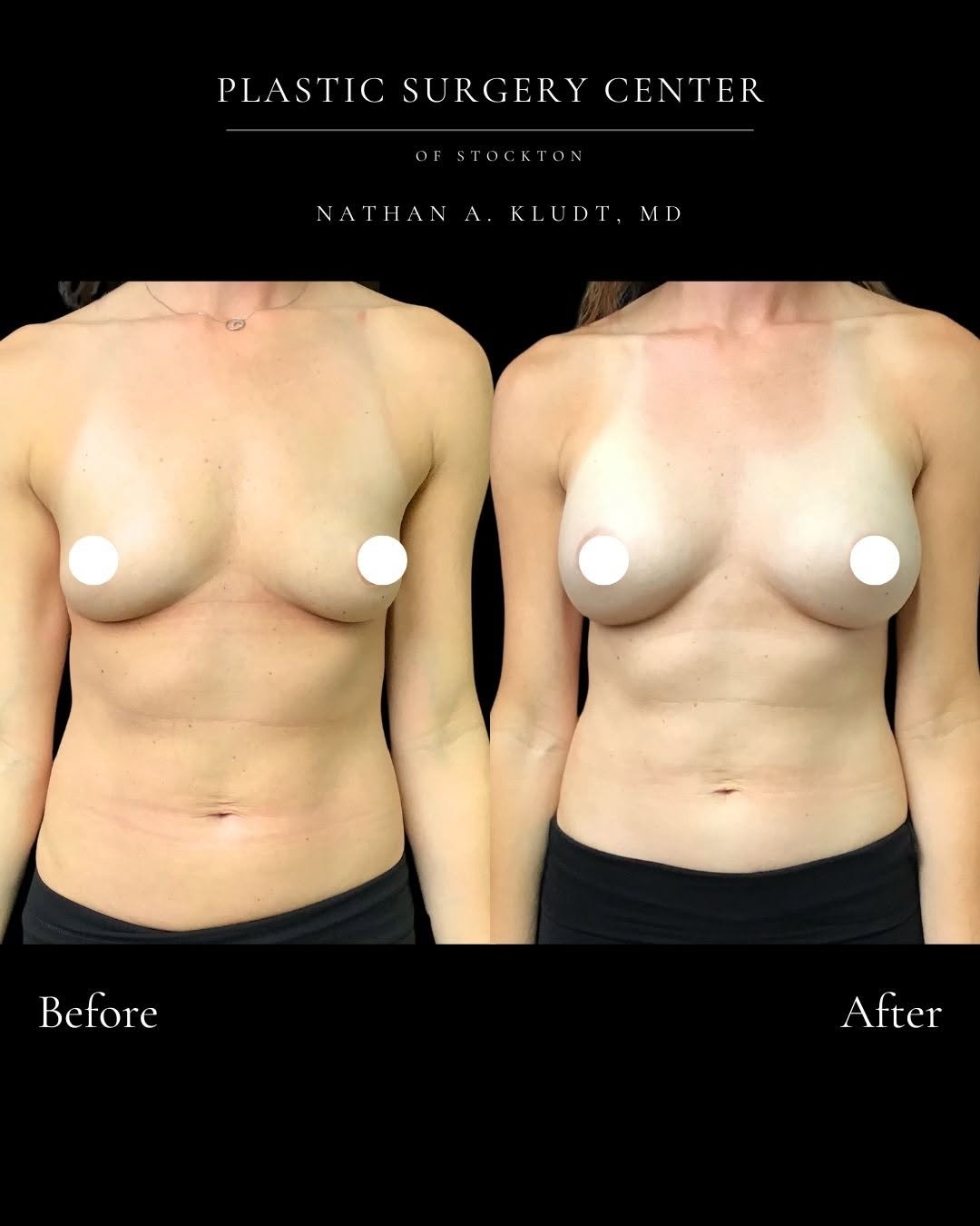 Instagram post by Dr. Nathan Kludt: A closer look at this breast augmentation result featuring 375cc implants. While implant size is an important part of the decision, choosing…