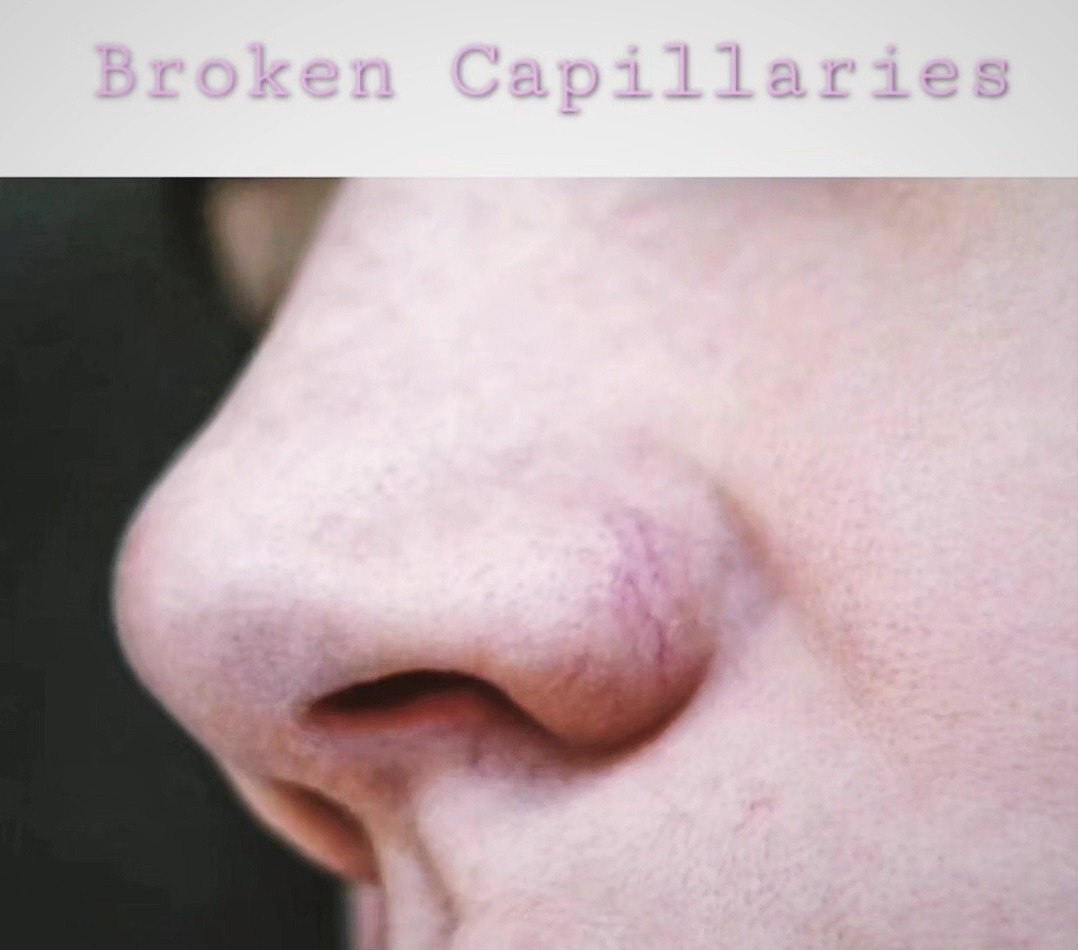 Instagram post by Dr. Nathan Monhian: Have you ever noticed tiny, web-like red or purple lines on your face or body? Those are known as broken capillaries, and they can be a commโฆ