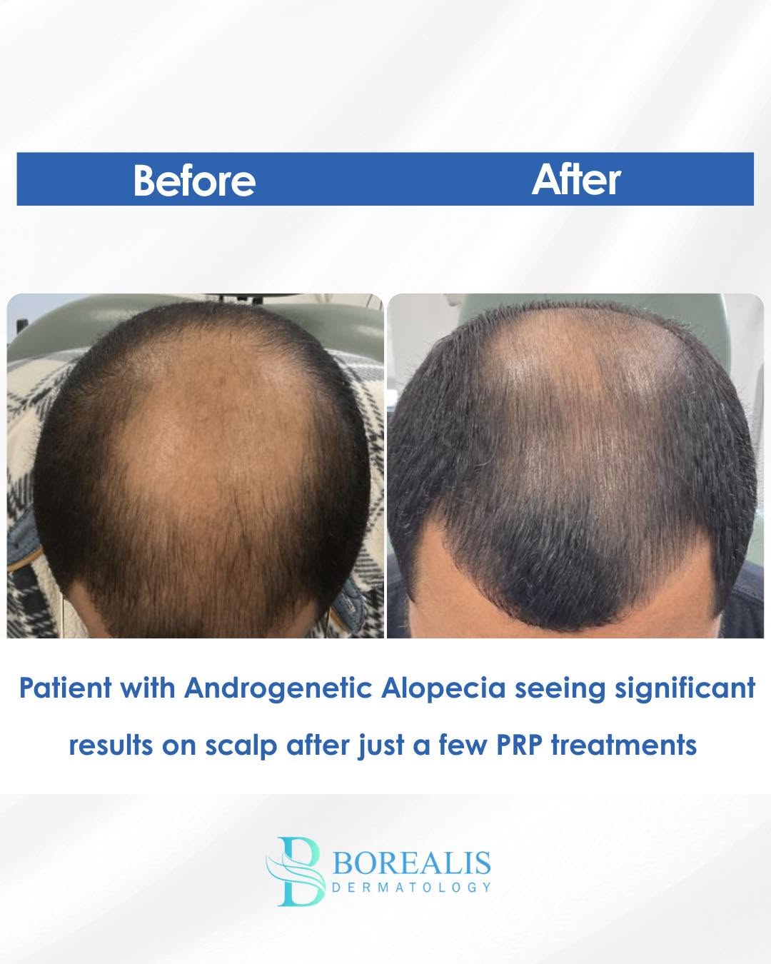 Instagram post by Dr. Navin S. Arora, DO, FAAD: Thinking about doing PRP for hair loss, call today for a consult. #Hempstead #LongBeachNY #LongBeachNY #medspa #GlenCove #ProtectYourSkin #s…