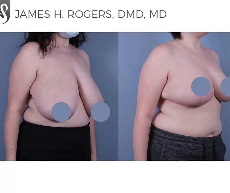 Instagram post by Dr. Navinderdeep S. Nijher: Take a look at this transformation! These before and after photos highlight the positive impact a breast reduction can have. If you’re strug…