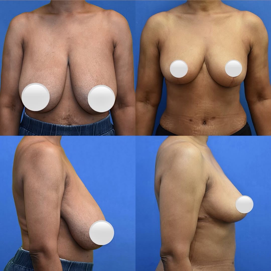 Instagram post by Dr. Neal Goldberg: This patient is ONLY 3 months post-op after undergoing a breast reduction. She went from heavy, drooping breasts to a smaller, lifted, more …