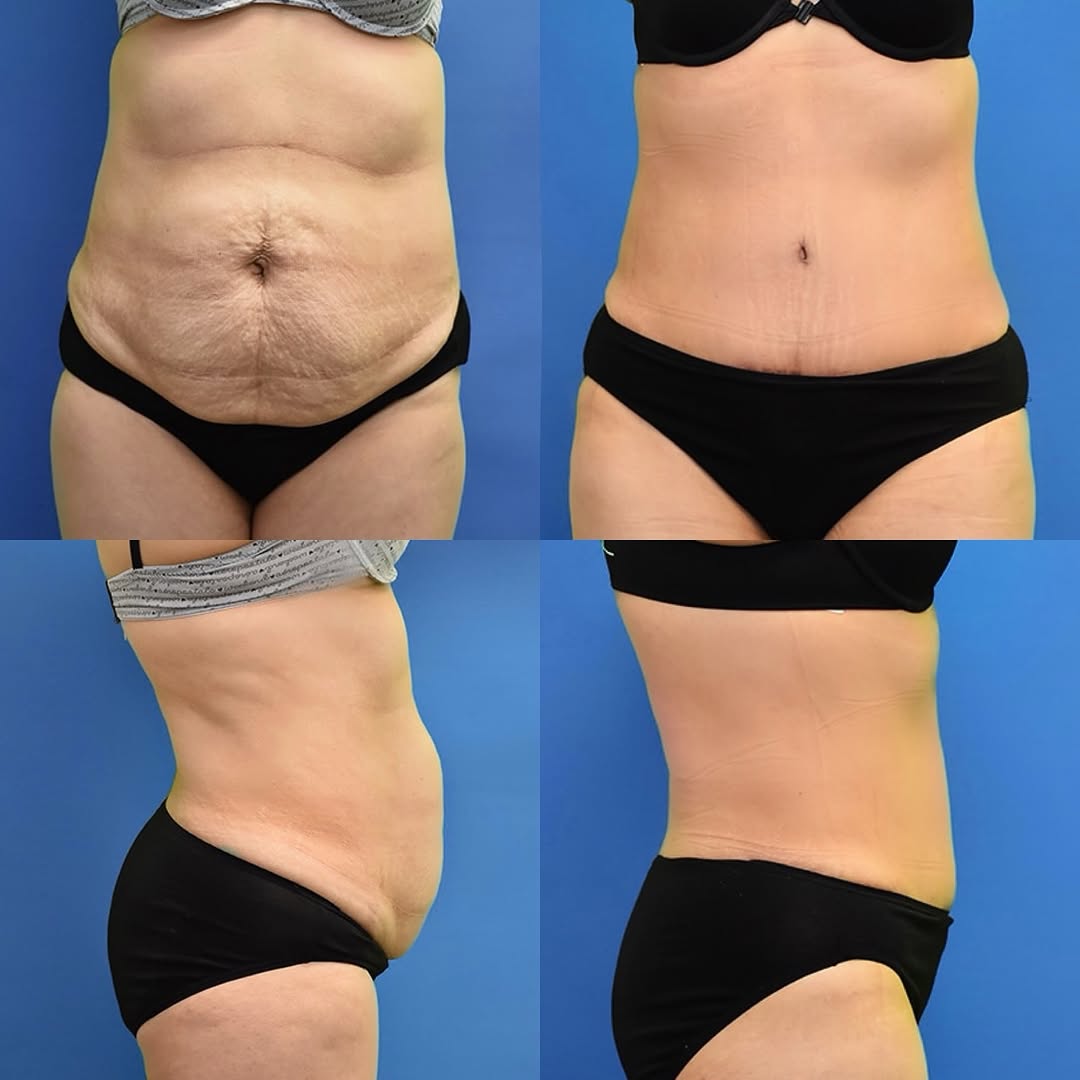 Instagram post by Dr. Neal Goldberg: This patient is only 6 weeks post-op after undergoing a tummy tuck. She had loose skin, stretch marks, and muscle separation that no amount …