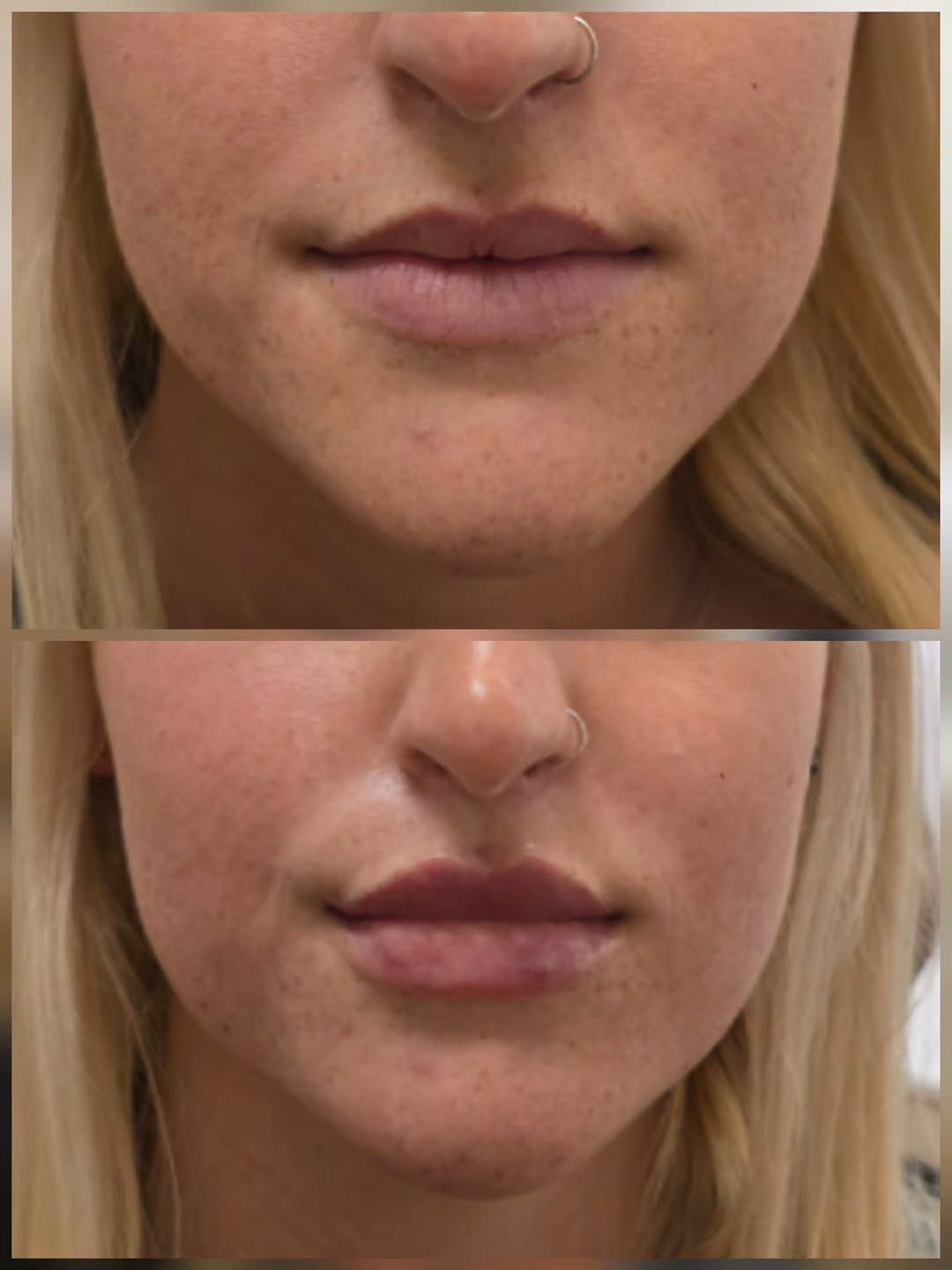 Instagram post by Dr. Neetu Nebhwani: Soft, balanced, beautifully enhanced. 💋✨ Call and make your appointment today 833-528-4310 #LipFiller #LipEnhancement #DermalFillers #Natur…