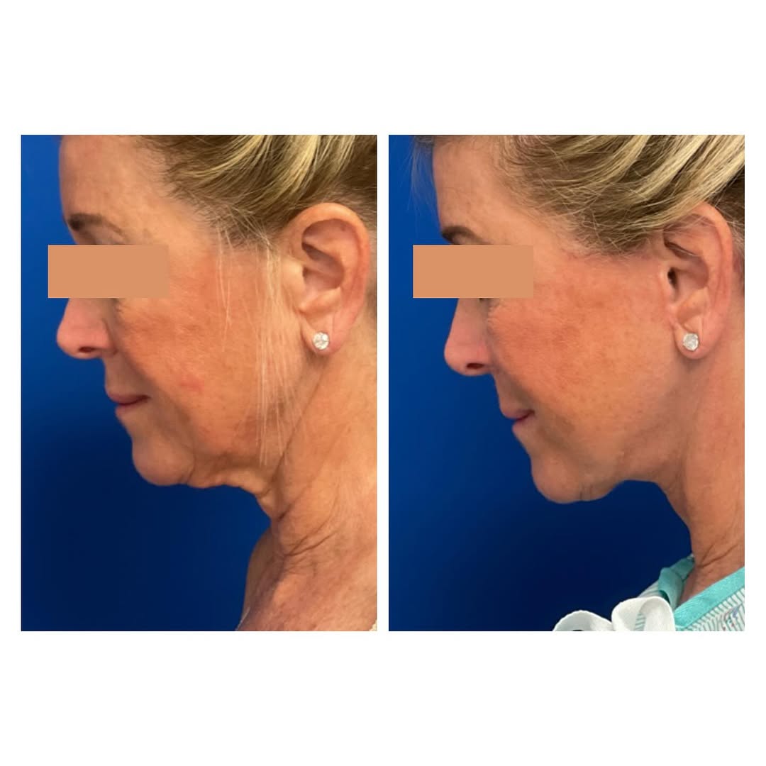 Instagram post by Dr. Neil Fine: Aging gracefully with a neck lift & facial fat grafting! Did you know that a neck lift can help redefine your jawline, eliminate excess skin…