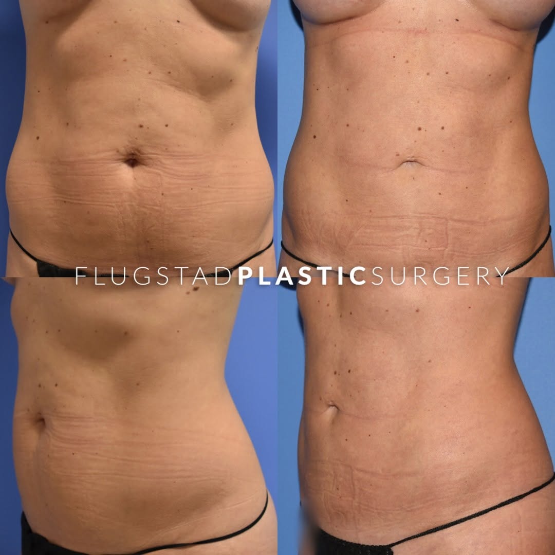 Instagram post by Dr. Nicholas A. Flugstad: This 39-year-old, female patient wished for shaping and fat removal focused on her mid and lower abdomen. She had liposuction on those areas…