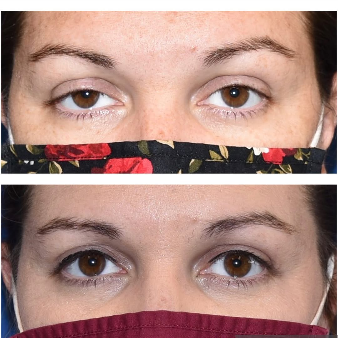 Instagram post by Dr. Nicholas A. Flugstad: Eyelid ptosis can keep many of us from being the most refreshed and awake. Repair of most upper eyelid ptosis is a short procedure with easy…