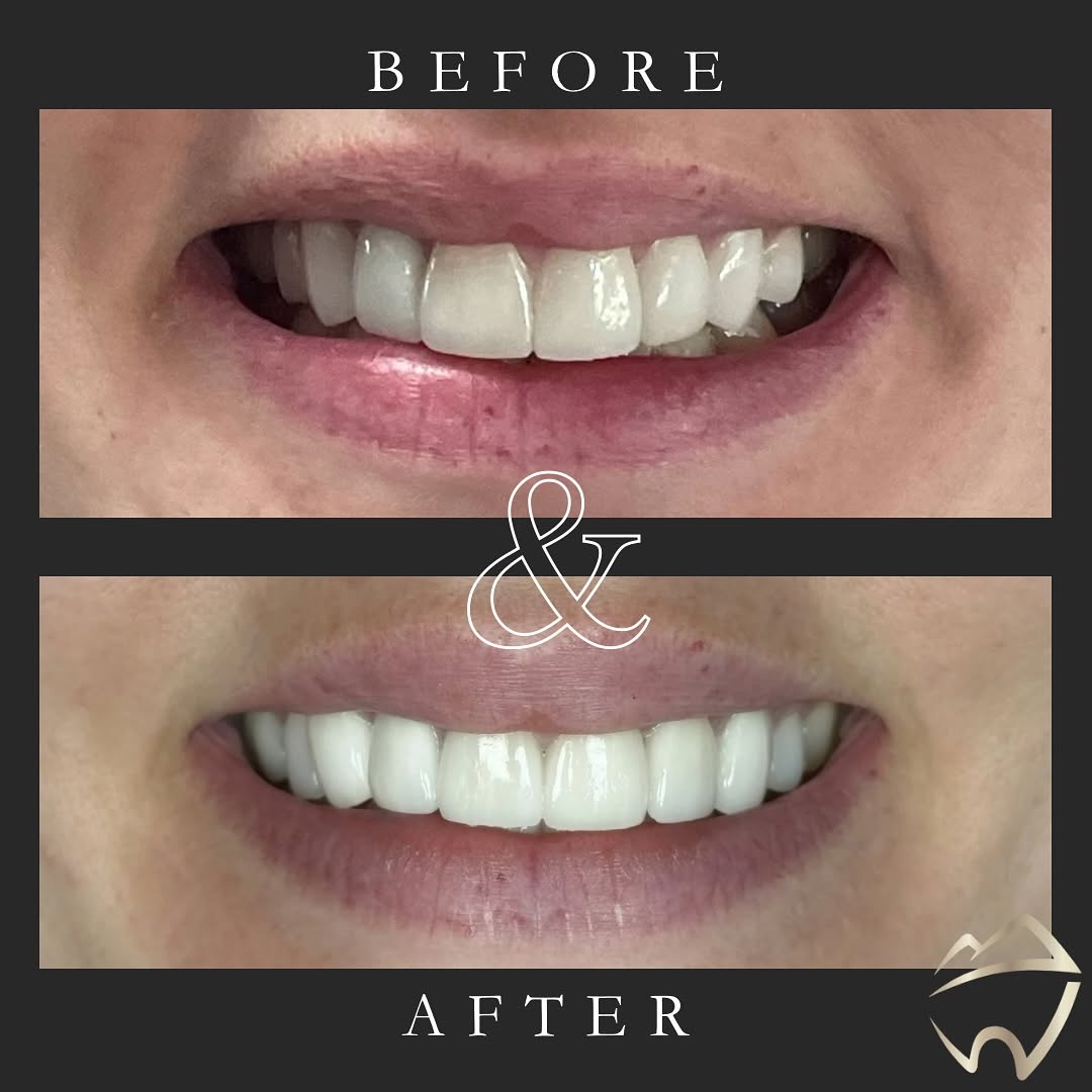 Instagram post by Dr. Nicholas Bottorff, DDS: This patient came to us after having veneers placed at another dental office, and unfortunately, she was unhappy with the result. Her concer…