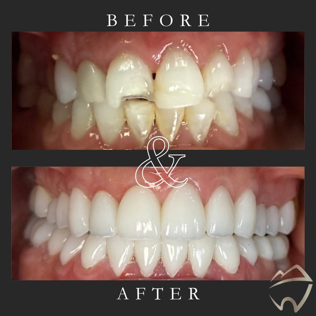 Instagram post by Dr. Nicholas Bottorff, DDS: ✨Stunning✨smile transformation and a great example of “Form Follows Function”. This patient initially sought out Dr. Bottorff to repair an a…