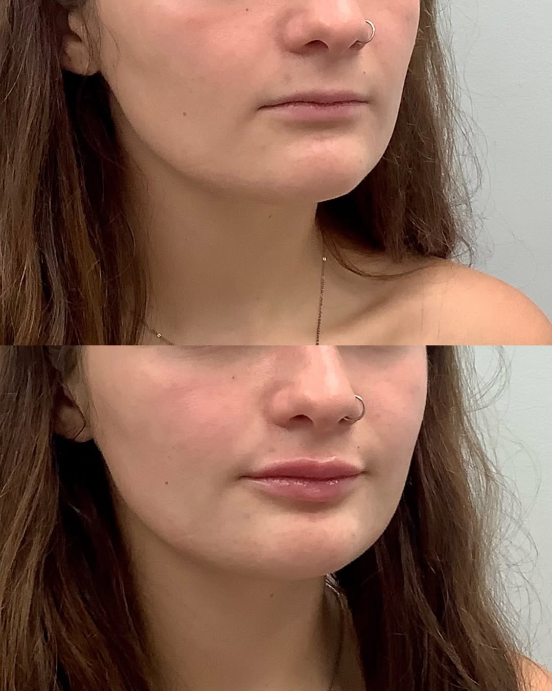 Instagram post by Dr. Nicholas Wingate: Building some height + adding some projection and hydration = your lips but better ✨ Book with me @legacyplastic ⬇️ 📞 (610) 524-8244 🔗 lin…