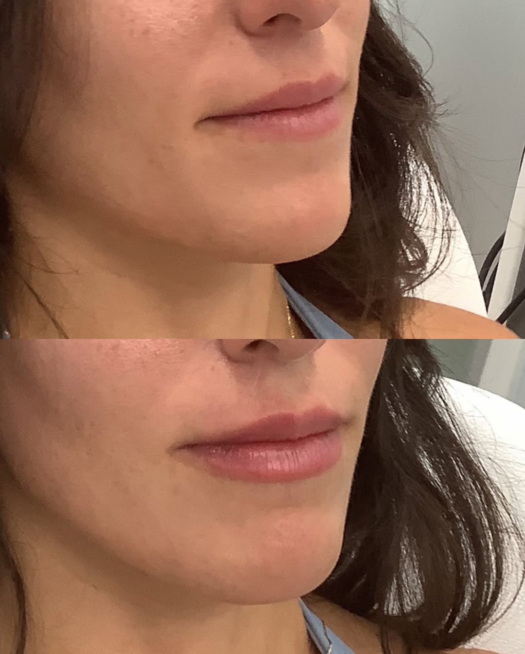 Instagram post by Dr. Nicholas Wingate: The goal: add volume The result: her lips, just elevated 🫶🏻 Now booking in January (when I get back from mat leave) links in bio! @legacyp…