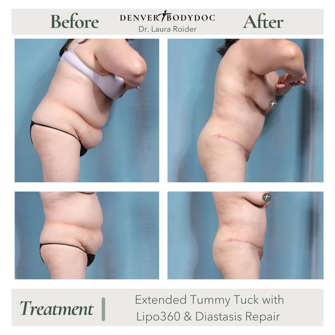 Instagram post by Dr. Nick Slenkovich: More than a flatter stomach. A restored core. Renewed confidence. @lauraroidermd performed an extended tummy tuck with Lipo360 and diastasis…